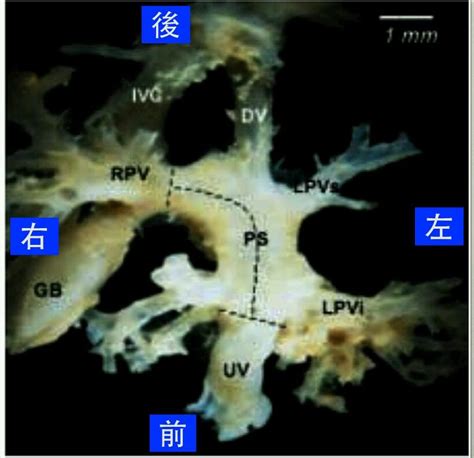 臍靜脈充氧血|孕兒診所賴錫鉅醫師 88 產前診斷持續性右側臍靜脈